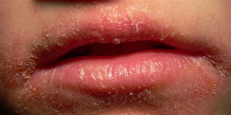 perioral dermatitis      annoying red face rash