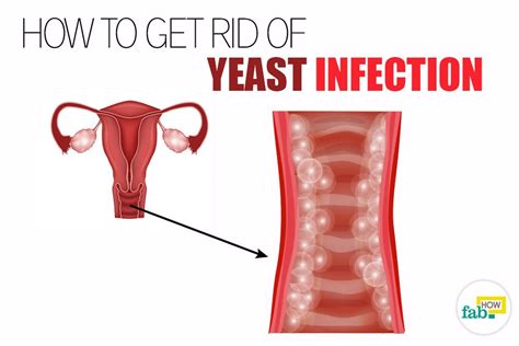 How To Get Rid Of A Yeast Infection And Get Immediate