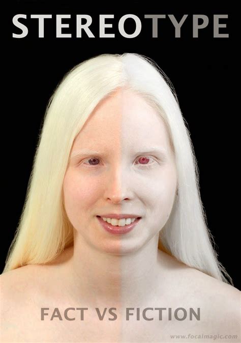 Люди Альбиносы Фото С Красными Глазами – Telegraph