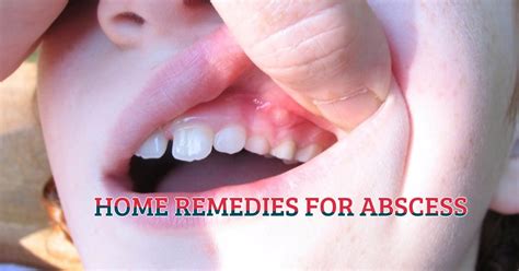 home remedies  abscess  life   drugs