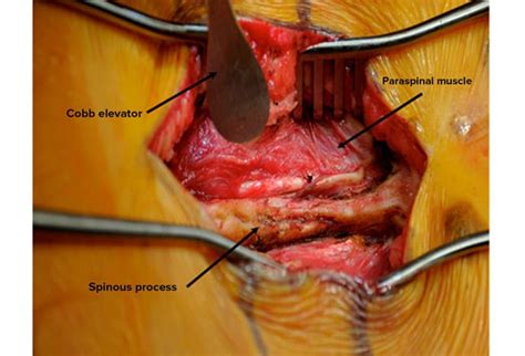 Spinal Decompression And Fusion