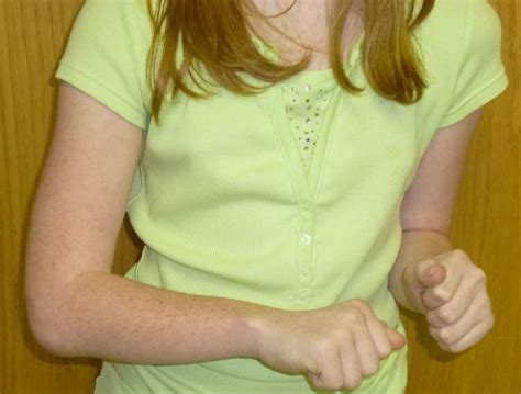 radioulnar synostosis revisited congenital hand  arm differences