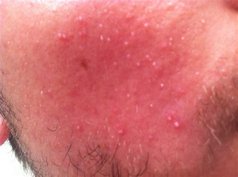 Tiny Whiteheads All Over Face Post Accutane Adult Acne By