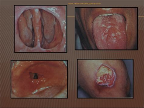 oral manifestations of sexually transmitted diseases