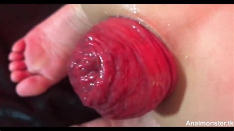 Huge Anal Prolapse Ruined Very Closeup Porn 59 Xhamster