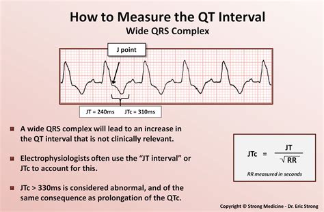 qt qtc interval measurement  wide qrs complex grepmed
