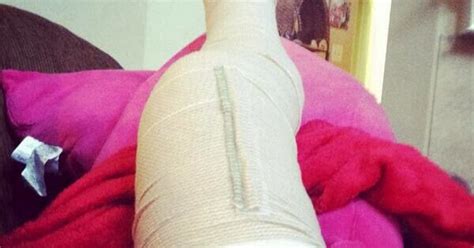 broken leg soft cast sprain broken ankle broken foot
