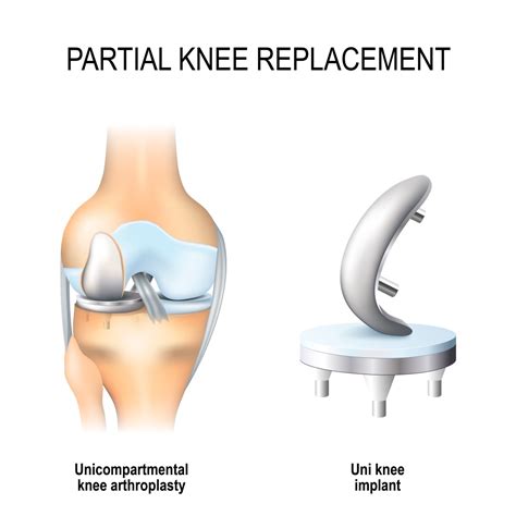 partial knee replacement    candidate