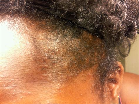 beautiful kinks sublimed sulfur scalp bumps part 2