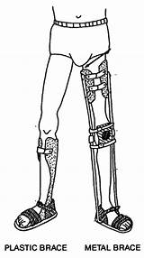 Brace Leg Braces Polio Devotee Metal Coloring Body Weak Legs Calipers Plastic Children Template Child Disabled sketch template