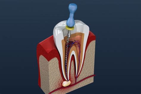 root canals safe pros  cons  root canal medical center dental group
