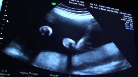 26 weeks 3 days ultrasound twins youtube