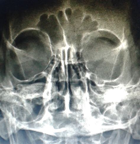dicas de radiologia como avaliar  qualidade da radiografia de seios da face mn