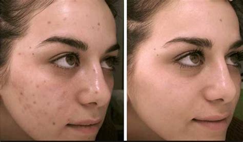 dark spots  face   removal ways skincarederm