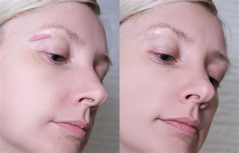 scar reduction true essence skin and laser med spa