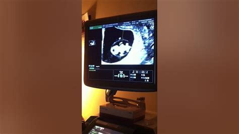 ourfirstsonogram youtube