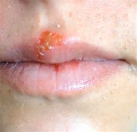 herpes vs cold sores are they different you ll be