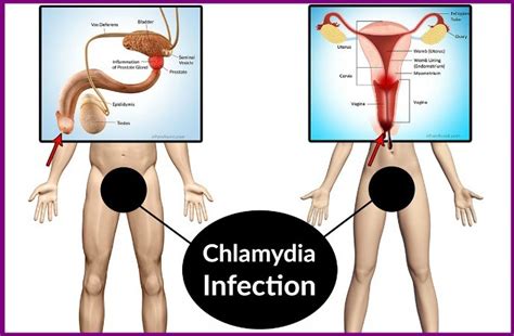 19 home remedies for chlamydia in men and women health and remedies