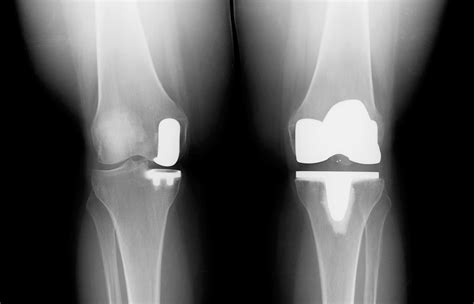 knee replacement buyxraysonline