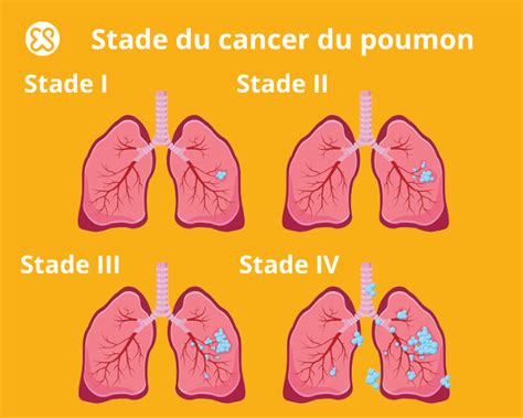 Esp Rance De Vie Stades Des Cancers Du Poumon Hot Sex Picture