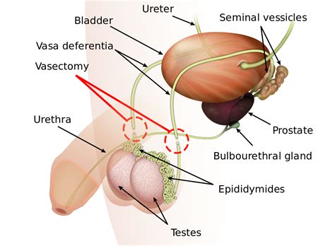 vasectomy wikipedia