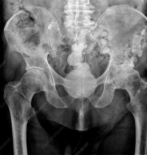 myeloma bone scan  ray stock image  science photo library