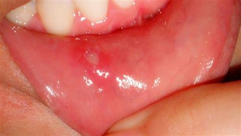 canker sore causes symptoms how to get rid of canker sores diseases lab