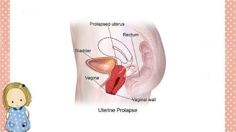 Uterus Prolapsed Treatment Youtube