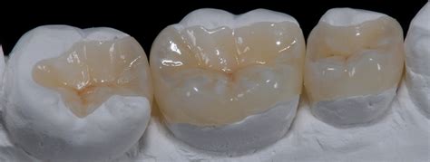 inlaysonlays normanview dental regina trusted regina dentists