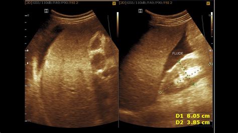 Ultrasound Cases 509 Of 2000 Huge Ascites Abdominal Lymph Adenopathy