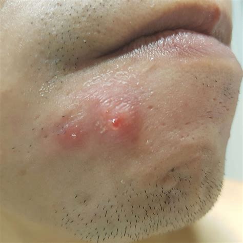 red lump general acne discussion