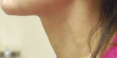 female bulging neck veins