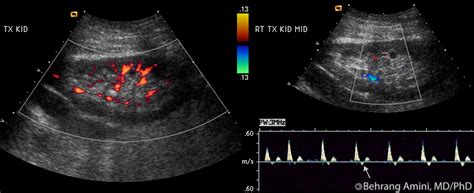 roentgen ray reader renal ultrasound  transplanted kidneys