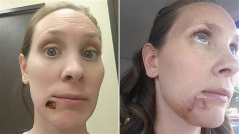 This Woman S Blackhead Turned Out To Be Skin Cancer Allure