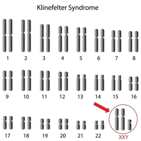 Klinefelter Syndrome Causes Karyotype Diagnosis Treatment