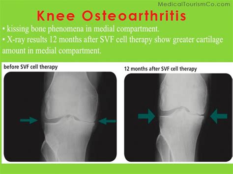 stem cell  osteorthritis  india affordable safe  legal procedure