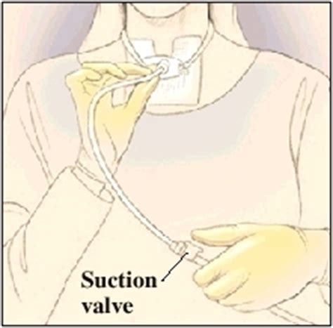discharge instructions caring   tracheostomy tube  stoma