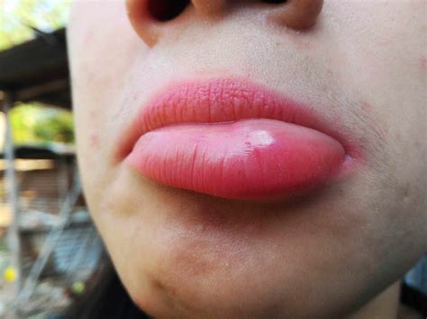 swollen bottom lip    reason treatment   lips swelling american celiac