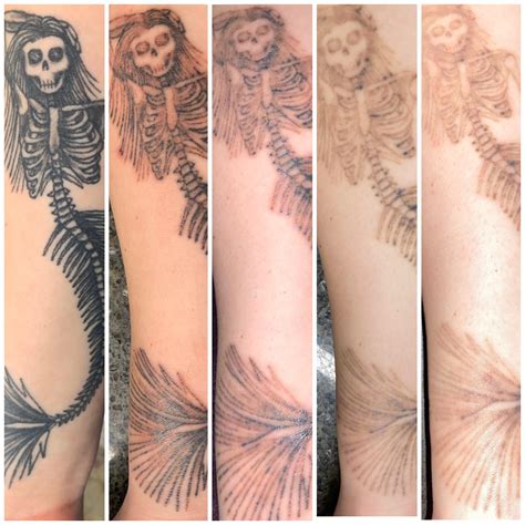 tattoo removal process pictures  sessions   process rtattooremoval