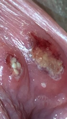 Ulcer Graphic Vulval Problems Forums Patient