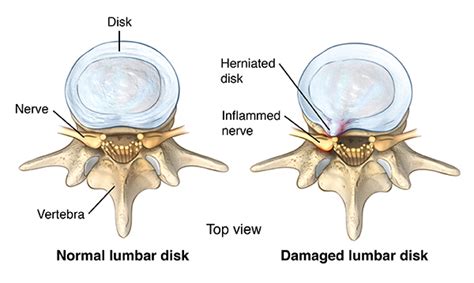 lumbar disk disease herniated disk saint lukes health system