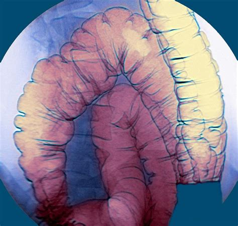 Large Intestine X Ray Photograph By Du Cane Medical Imaging Ltd Fine