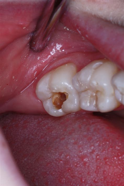tooth decay    cavity    uxbridge family