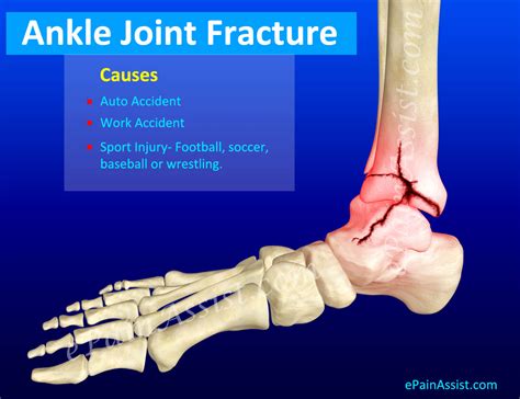 ankle joint fracturetypesclassificationsymptomstreatmentrecovery