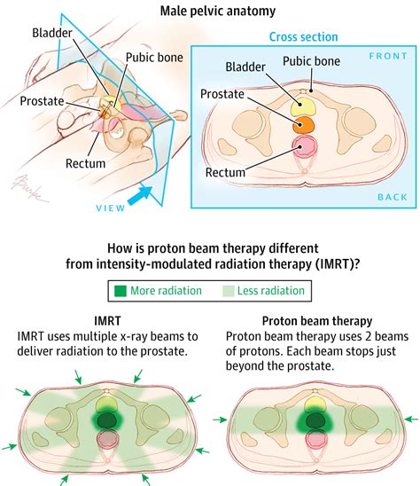 proton beam therapy  prostate cancer targeted  immune cancer