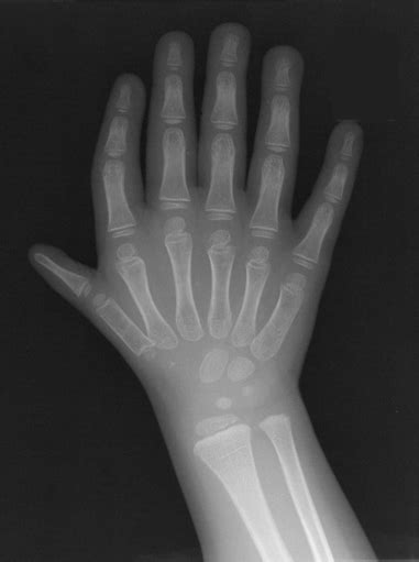 triphalangeal thumb bone and spine