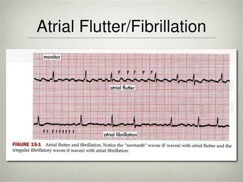 Ppt Atrial Flutter And Atrial Fibrillation Powerpoint Presentation