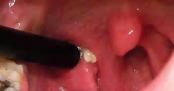 tonsil stones symptoms and 10 home natural treatments the science of eating