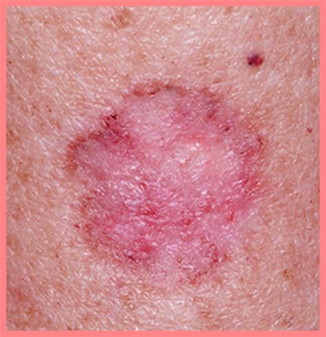 skin disease picture pictures
