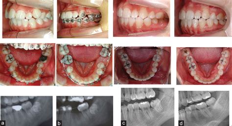 molar protraction  uprighting  molar protraction    molar